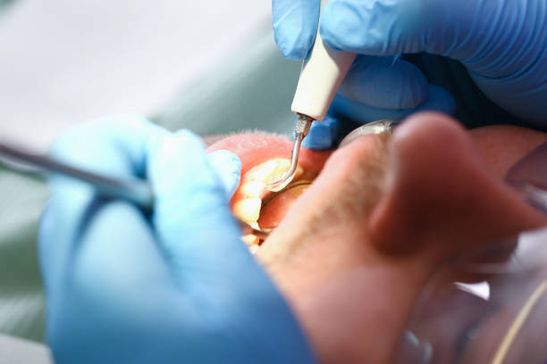 Best Dental Abscess Treatment in Homewood, SC